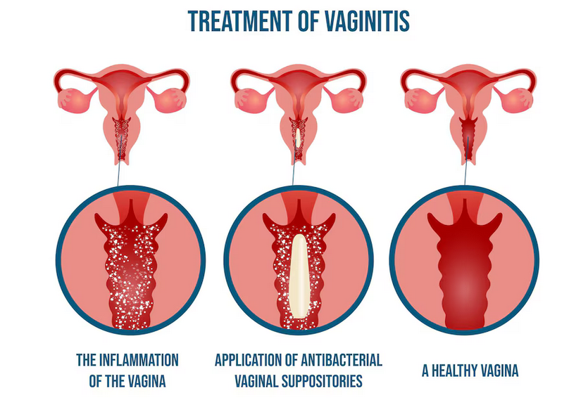 علاج التهاب المهبل الجرثومي (البكتيريا المهبلية)